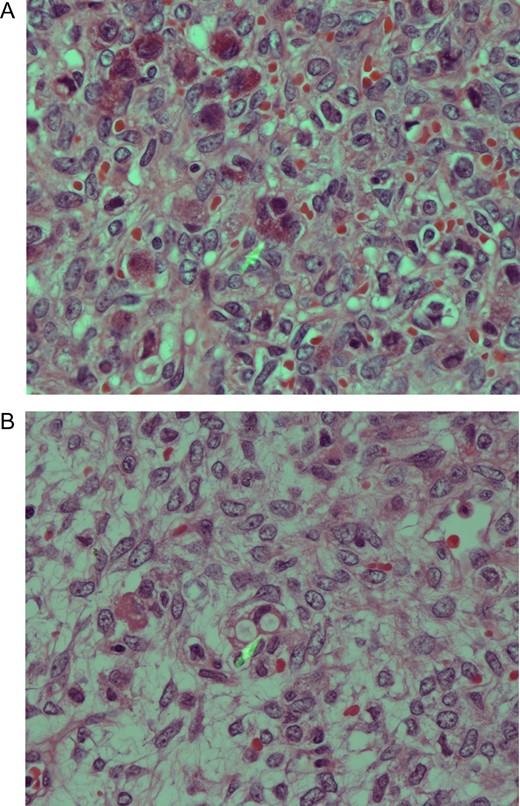 (A) Poorly differentiated carcinoma showing a mixture of vacuolated signet ring-cell malignant cells, some of which with eosinophilic cytoplasmic granules consistent with Paneth cells differentiation (PCD). H/E stain ×400. (B) Metastatic adenocarcinoma with signet ring cells morphology. Note also the presence of malignant cells containing orangophilic granules indicating PCD.