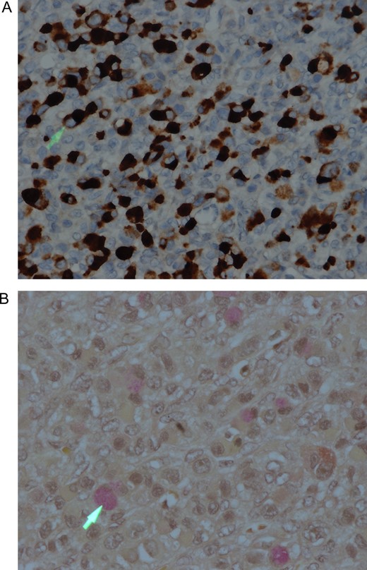 (A) Tumor cells showing strong positive cytoplasmic staining with the EMA immunohistochemistry. IHC stain ×200. (B) Tumor cells showing intracytoplasmic mucin, which is highlighted by the mucicarmine special stain (arrowhead). Mucicarmine stain ×400.