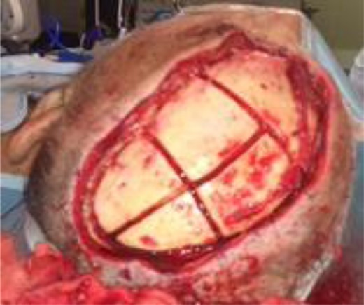 Case 2: Outer cortex sectioned.