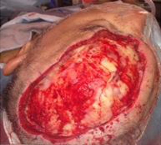 Case 2: Inner cortex intact.