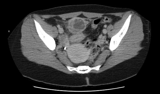 Axial plan of the CT showing the urachal cyst.