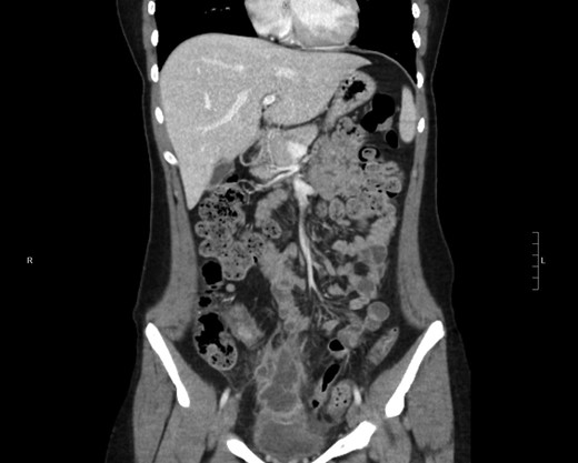 Coronal plan of CT abdomen/pelvis showing the urachal cyst above bladder.