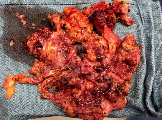 Inflamed and necrotic appearance of the urachal cyst with multiple pus filled cavities.