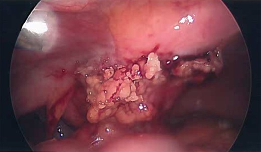 Laparoscopic view of the urachal cyst, viewing the umbilical portion of the urachus.