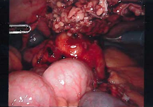 Laparoscopic view of the urachus while dissection, view of the dome of the bladder and dissection of median umbilical ligament.