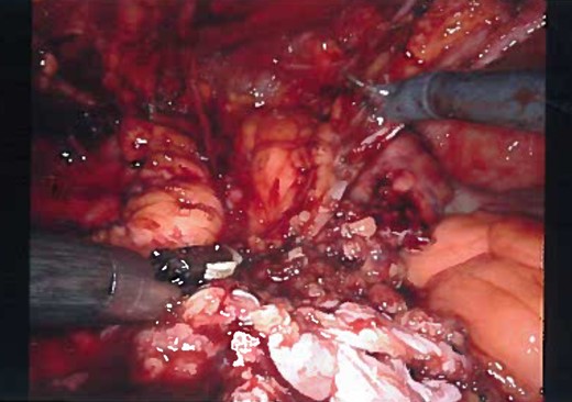 Laparoscopic view of the dissection, most of the cyst is dissected and over-sewing the dome of the bladder.