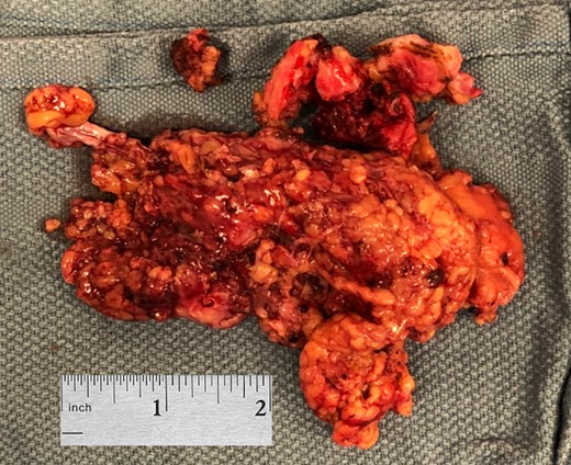 Gross appearance of the urachal cyst.