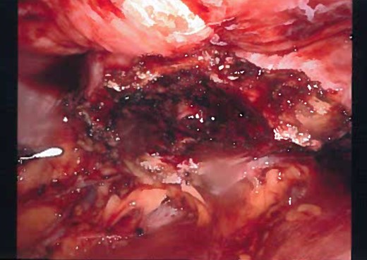 Laparoscopic view of the complete dissection of the cyst before removing the port.