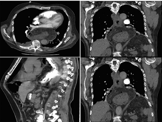Hiatus hernia with associated mural thickening of esophagus and locules of gas showing localized perforation.