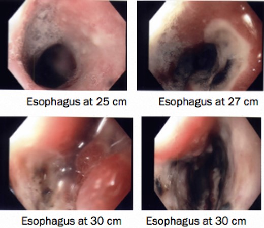 Patchy gangrenous esophagus from 24–30 cm.