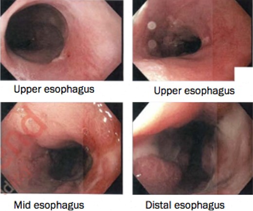Healing mucosal ischemia from upper, mid and distal esophagus.