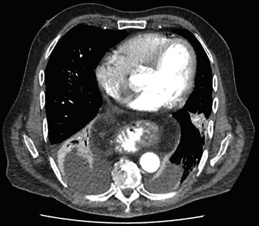 CT scan at 2 weeks showing no contrast extravasation in posterior mediastinum.
