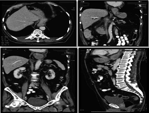 Hiatus hernia with associated mural thickening of esophagus.