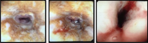 Circumferential ischemia/necrosis in distal esophagus.