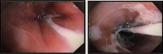 Interval endoscopy at 2 weeks showing signs of healing (Superficial slough at the area of partial necrosis).