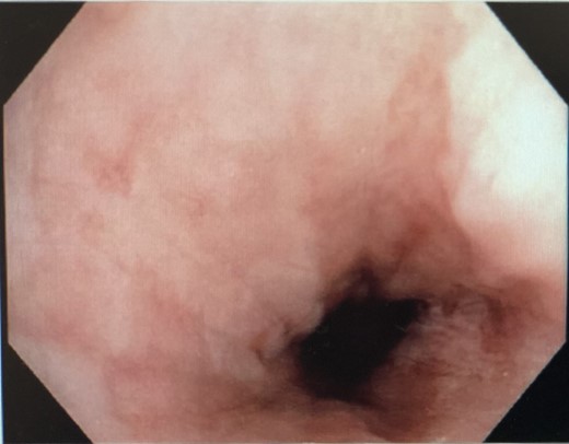 Normal esophageal mucosa at 8 weeks.