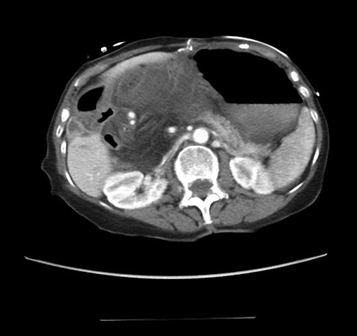 Bowel passing into the foramen of Winslow.