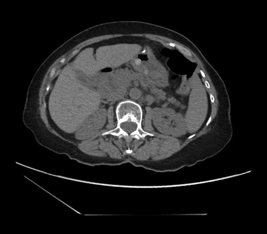 Externalized abdominal contents shown to be pink and healthy bowel with some areas of ecchymosis in the transverse colon.