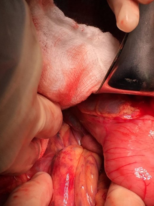 Loops of bowel between IVC, liver, and lesser curvature of the stomach. Arrow small bowel. Arrow head stomach.