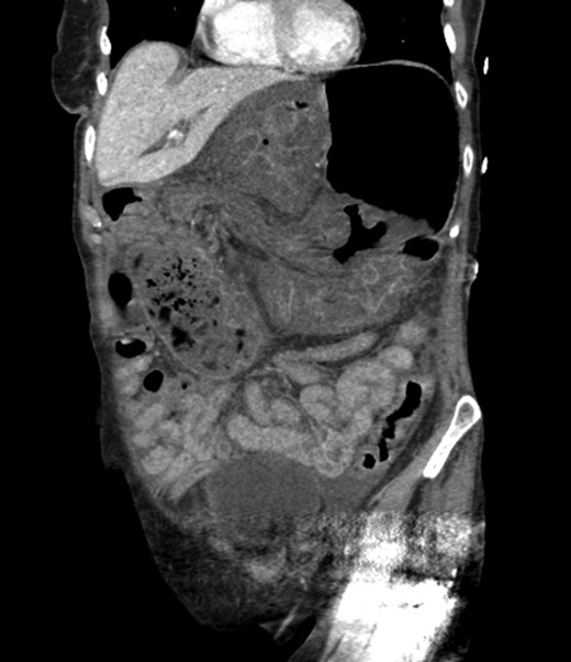 CT scan from four years prior to presentation showing evidence of foramen of Winslow hernia. Arrow head on stomach. Arrow on bowel.