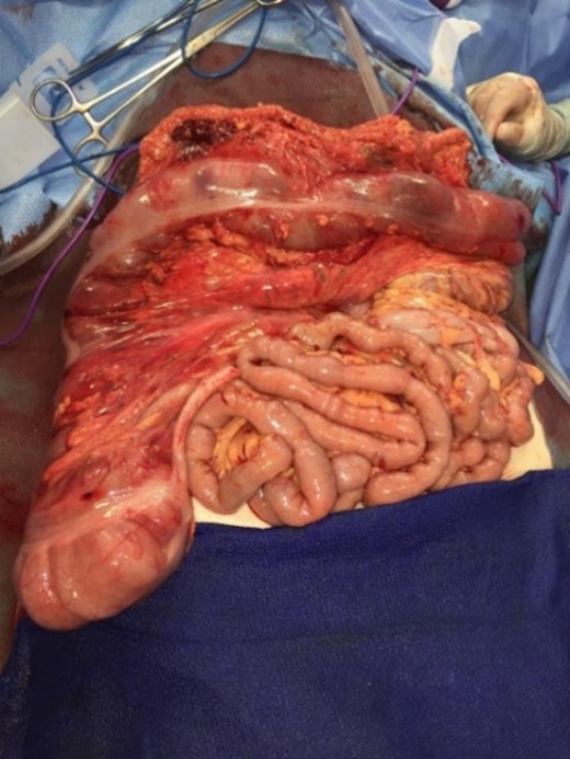 CT abdomen and pelvis coronal view of foramen of Winslow hernia.