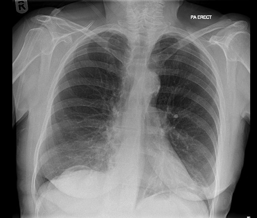 CXR showing pneumoperitoneum.