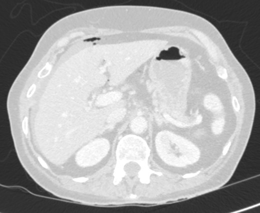 CT showing pneumoperitoneum.