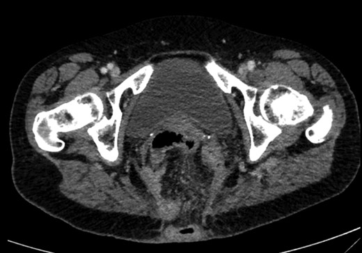 CT showing small bowel loops in pelvis with perineal hernia and free fluid.