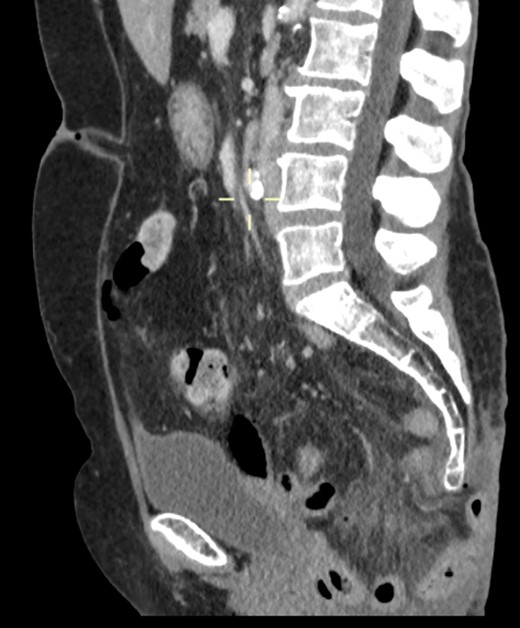 Sagittal view showing small bowel loops in pelvis with perineal hernia.