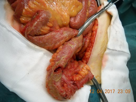 Loop of adherent small bowel stuck in perineal hernia with sites of perforation.