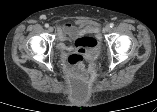 Postoperative complication.