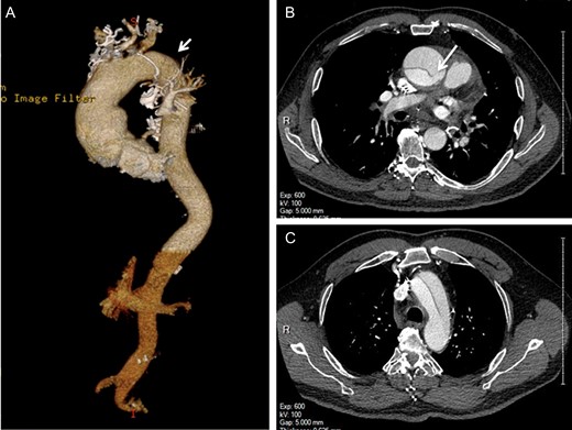 Preoperative computed tomography angiography shows the type A aortic dissection with intimal flap extending from the sinotubular junction to the proximal descending thoracic aorta (A, arrowhead). The primary entry tear is located in the ascending aorta (B, arrow). The re-entry intimal tear is not identified (C).
