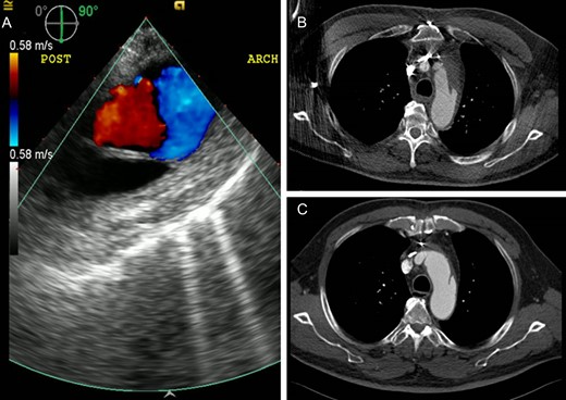 Echocardiography and computed tomography demonstrate the changes of the residual false lumen in the distal aorta. (A) Absence of blood flow in the false lumen on transesophageal echocardiography after the repair. Follow-up computed tomography scans showing interval thrombosis of the false lumen on postoperative Day 5 (B) and complete resolution of the false lumen at 1 month (C).