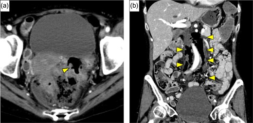 (a) Enhanced abdominal CT showed free air around the rectum (yellow arrow), and strongly suggested perforation of the rectum. (b) Massive continuous pneumoretroperitoneum from rectum was revealed (yellow arrows).