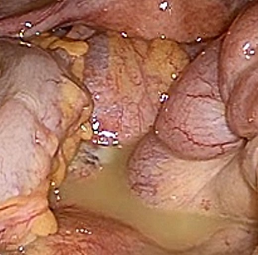 Laparotomy revealed the peritoneal fluid collection.