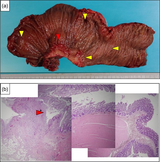 (a) The resected specimen showed perforation at the rectum (red arrow), and diverticulitis was apparent (yellow arrows). (b) A photomicrograph showed diverticulum perforation over the posterior wall of the rectum (red arrow).