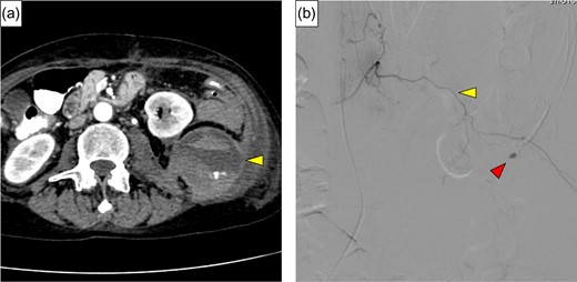 (a) Contrast extravasation from lumbar artery and hematoma expansion lifting the left kidney was identified (yellow arrow). (b) Angiography revealed extravasation of contrast medium (red arrow) from the left first lumbar artery (yellow arrow).