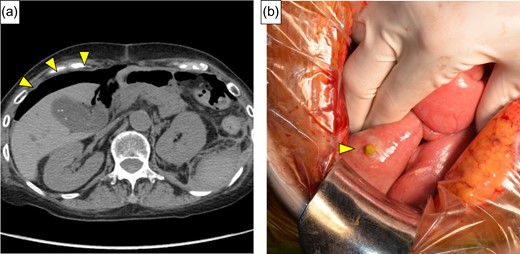 (a) CT showed free air around the right lateral region (yellow arrows). (b) Intraoperative findings showed perforation of the cecum with no obvious masses (yellow arrow).