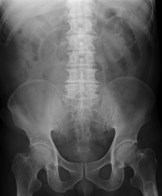 Plain abdominal radiographs suggested subileus.