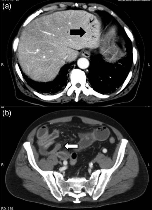 Contrast-enhanced abdominal CT revealed HPVG (a, black arrow) and thickening of the appendix (b, white arrow).