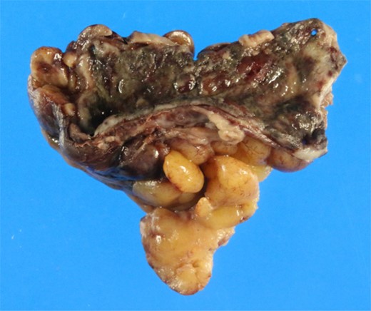 Gross pathology of the gangrenous appendicitis. Although the appendix wall was markedly thickened and fragile, no macroscopic perforation was observed.