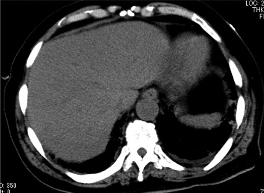 Abdominal CT on Day 7 after the surgery showed that HPVG had disappeared.