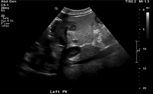 Right upper quadrant ultrasound showing left portal vein thrombosis (arrow).