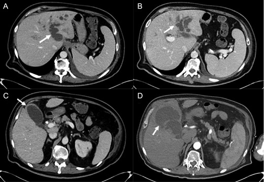 Abdominal imaging findings: axial computed tomography (CT) scan showing the intrahepatic dilation of the left sided biliary system (arrow) from cranial (A) to caudal (B), diffusely thickened gallbladder wall (C, arrow) and left intrahepatic abscess (D, arrow).