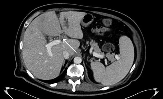 Axial CT scan showing thrombosis of the left portal vein (arrow).