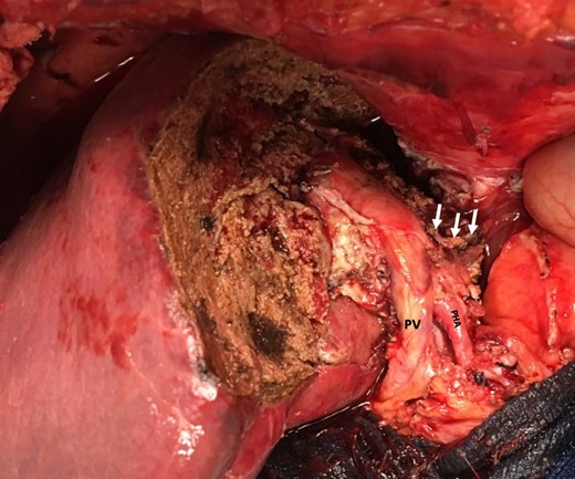 Remnant liver after left extended hepatectomy with preserved hilar structures (portal vein (PV), proper hepatic artery (PHA) and staple line after resection of left portal vein (arrows)).