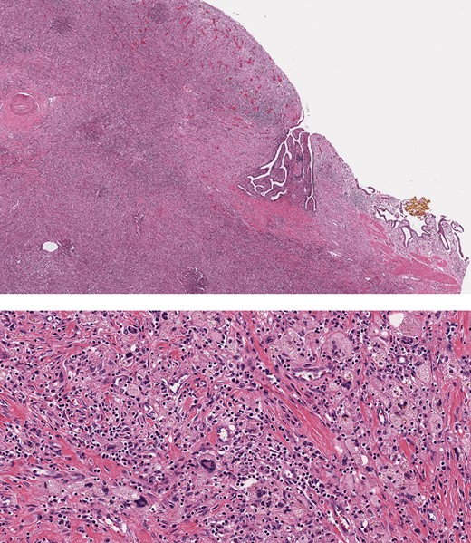 Histopathology, showing transmural inflammatory process in the gallbladder with mucosal ulceration (top) and the mass lesion composed of sheets of foamy histiocytes admixed with plasma cells, lymphocytes, collagen fibers and scattered giant cells (bottom).