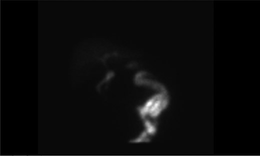 HIDA scan showing acute cholecystitis.