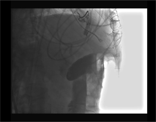 Fluoroscopy: colonic perforation.