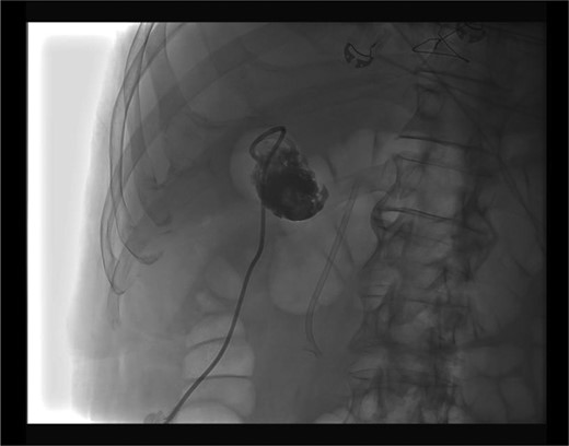 Fluoroscopy: properly positioned cholecystotomy tube.